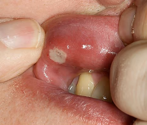 Image 1 of Canker Sores