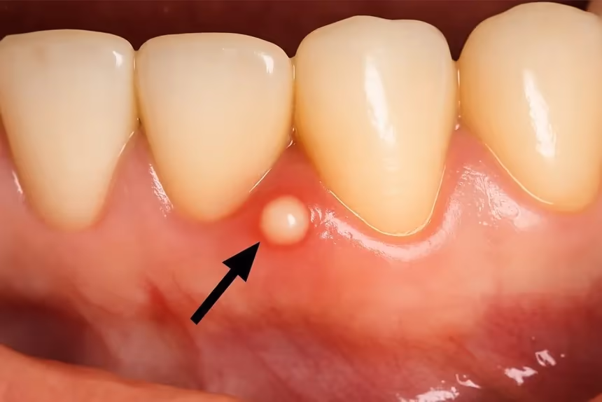 Image 1 of Dental Abscess