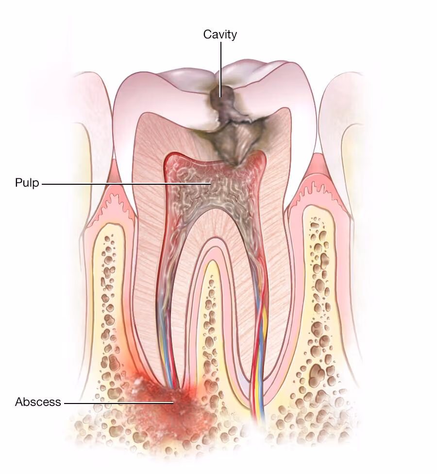 Image 2 of Dental Abscess
