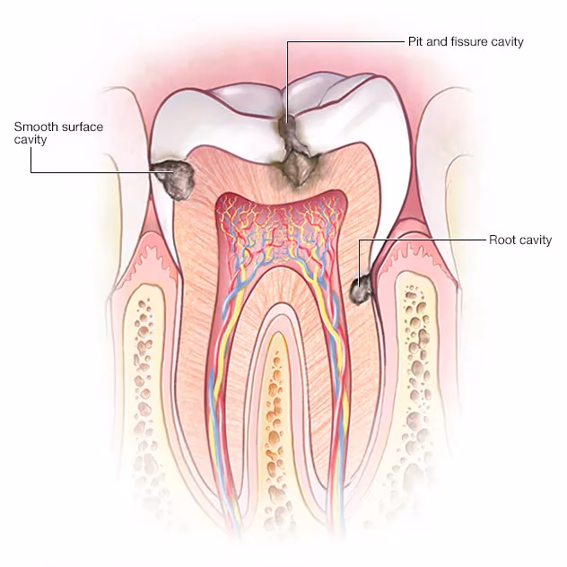 Image 2 of Dental Caries