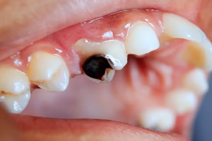 Image 1 of Dental Caries
