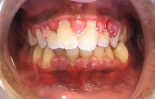 Image 1 of Gingivitis