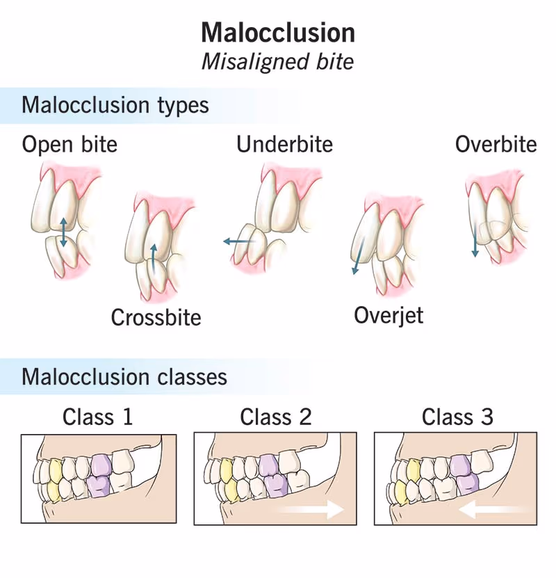 Image 1 of Malocclusion