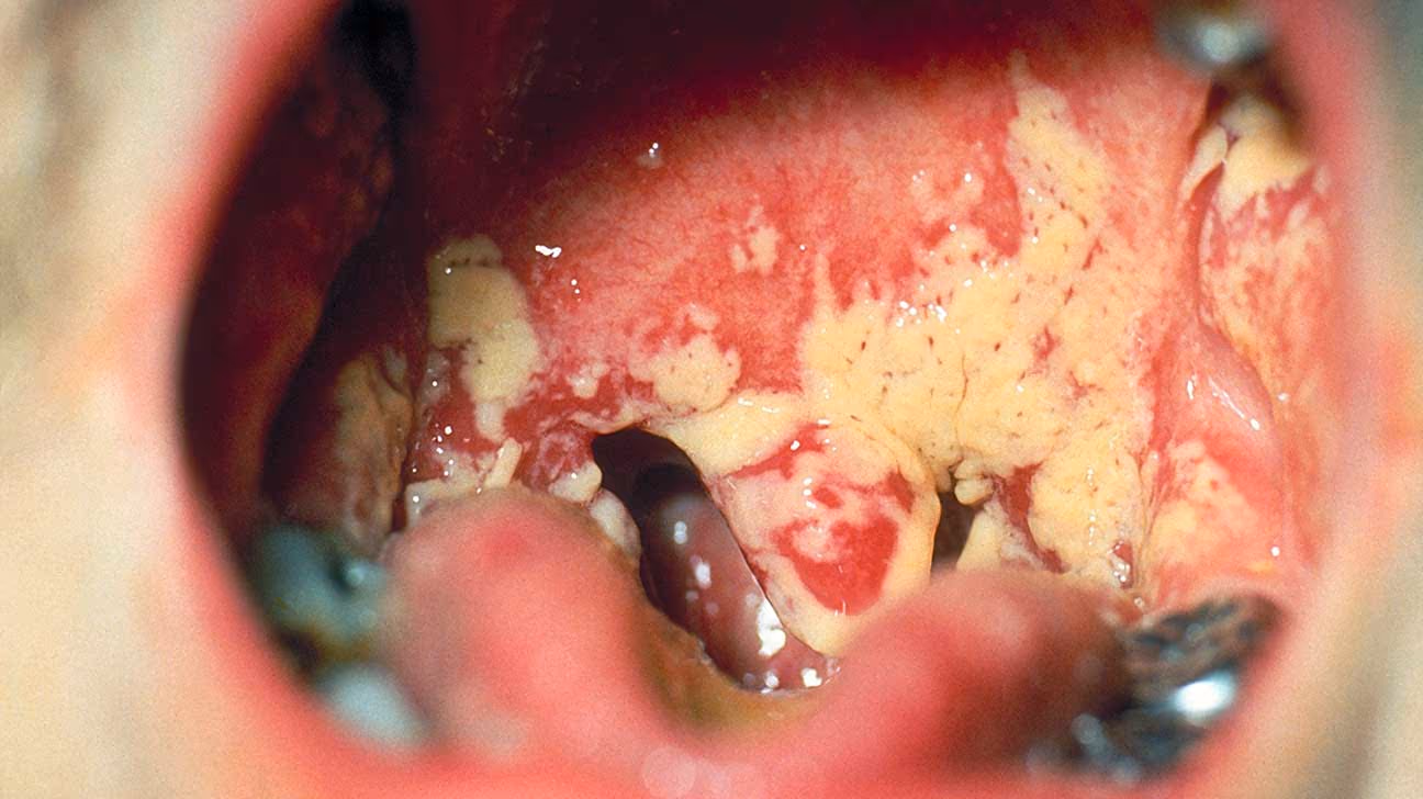 Image 1 of Oral Thrush