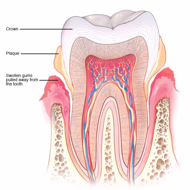 Image 2 of Periodontitis