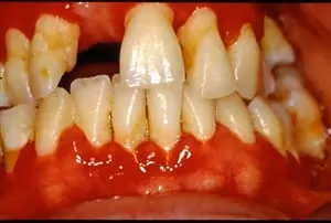 Image 1 of Periodontitis