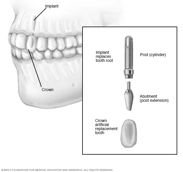 Image 1 of Dental Implants