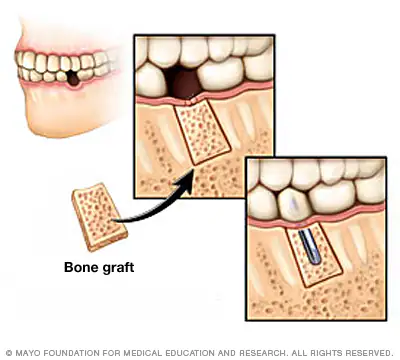 Image 2 of Dental Implants