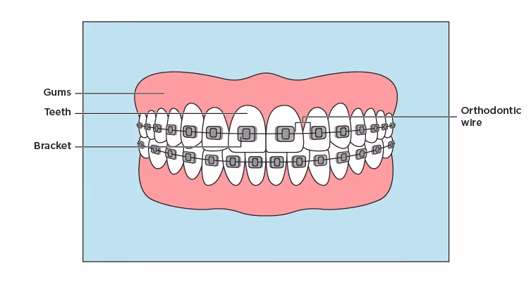 Image 2 of Orthodontic Braces