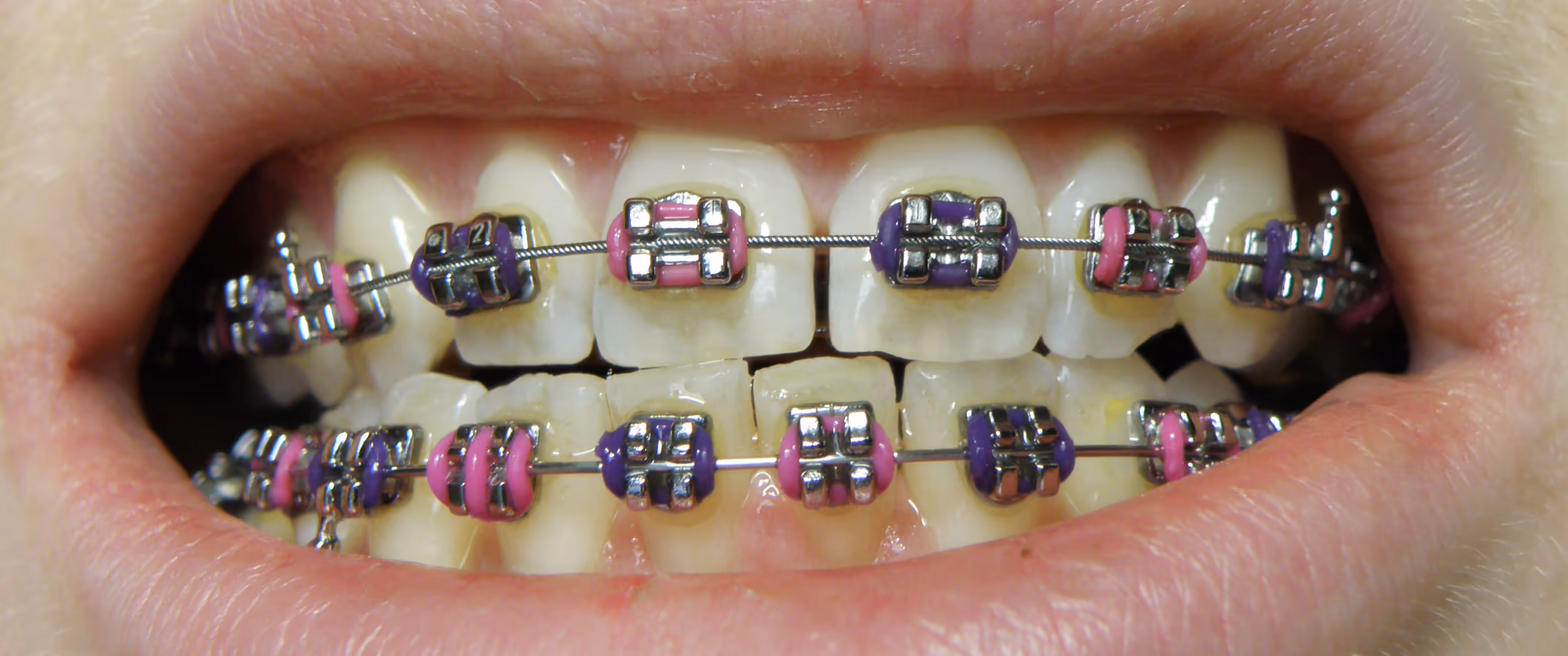 Image 1 of Orthodontic Braces