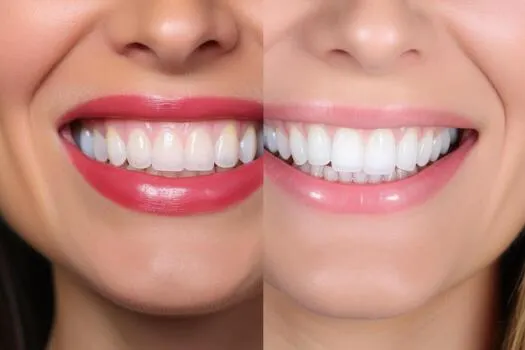Image 2 of Teeth Whitening