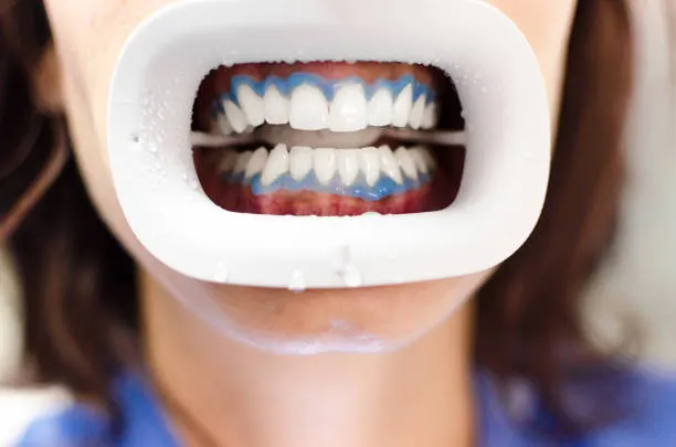 Image 1 of Teeth Whitening